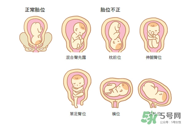 胎位不正如何矯正？胎位不正一定要剖腹產(chǎn)嗎？