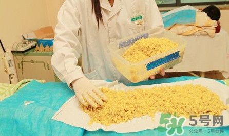 隔姜灸效果怎么樣？隔姜灸好還是直接灸好