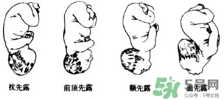 胎位不正能順產(chǎn)嗎？胎位不正怎么辦？