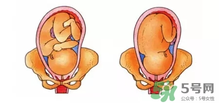 胎位不正能順產(chǎn)嗎？胎位不正怎么辦？