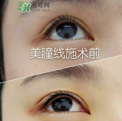 做美瞳線可以吃雞蛋嗎？做美瞳線能吃雞蛋嗎？