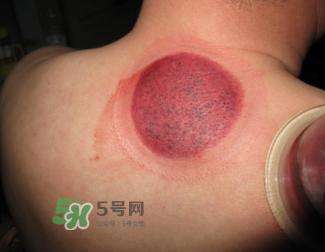 三伏天拔罐后多久可以洗澡？三伏天拔罐后注意事項(xiàng)