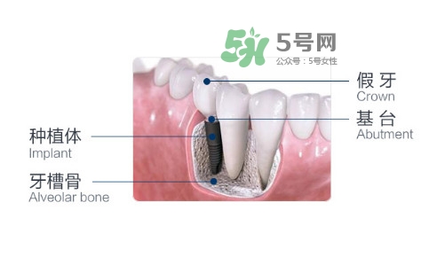 種植牙費(fèi)用多少錢(qián)？國(guó)產(chǎn)種植牙價(jià)格