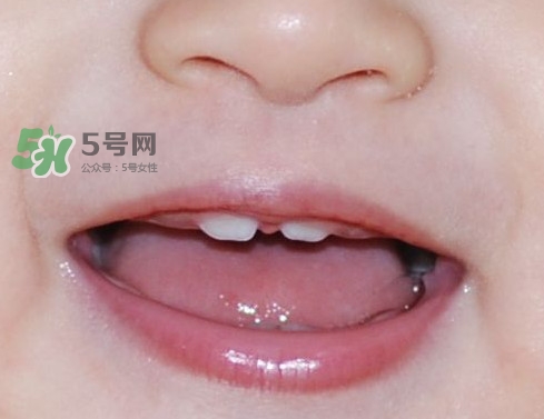 牙齒縫隙大怎么辦？牙縫大帶牙套有用嗎