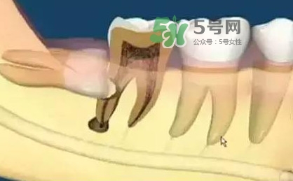 智齒是每個(gè)人都會(huì)長(zhǎng)嗎？拔智齒能瘦臉嗎？