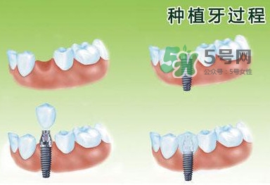 種植牙費(fèi)用多少錢(qián)？國(guó)產(chǎn)種植牙價(jià)格