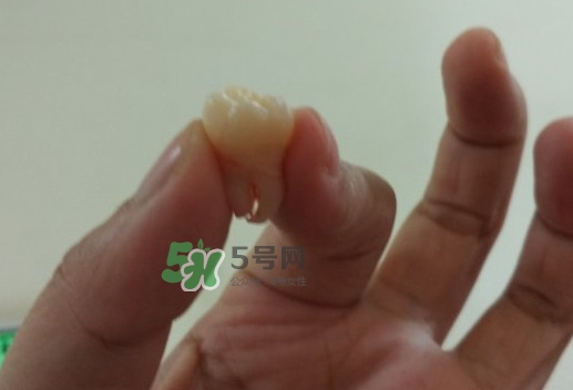 拔智齒痛嗎？智齒拔了多久洞會好？