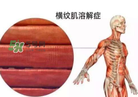 橫紋肌溶解癥會(huì)死亡嗎？橫紋肌溶解癥能活多久