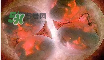 多胞胎是怎么生產的？多胞胎應選擇什么分娩方式
