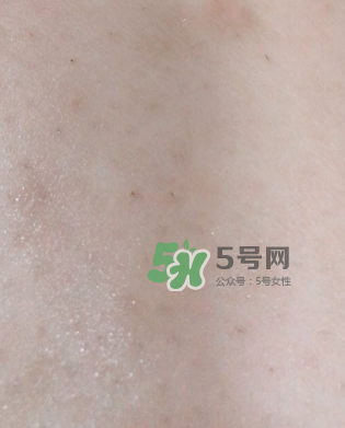 Dermatix舒痕疤痕膏有效嗎？Dermatix舒痕疤痕膏怎么用？