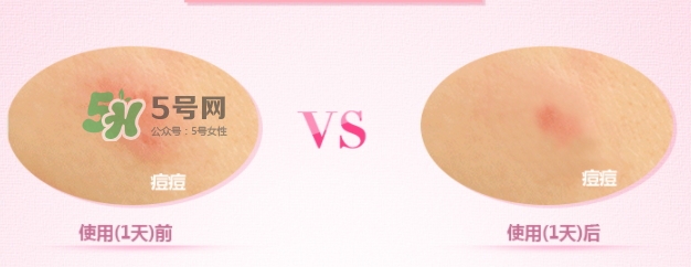 3m痘痘貼怎么用？3m痘痘貼貼多久？