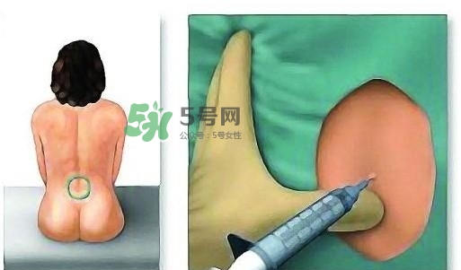 無痛分娩為什么不提倡？無痛分娩有后遺癥嗎？