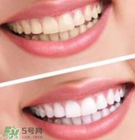 碧緹福美牙儀對牙齒有傷害嗎？碧緹福美牙儀會反彈嗎？