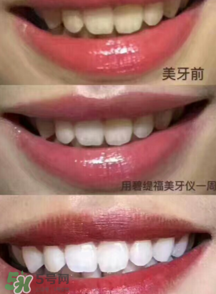 美牙儀能用水洗嗎？美牙儀能用多久？