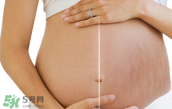 妊娠紋在左邊生男或女？怎么從妊娠紋看男女？