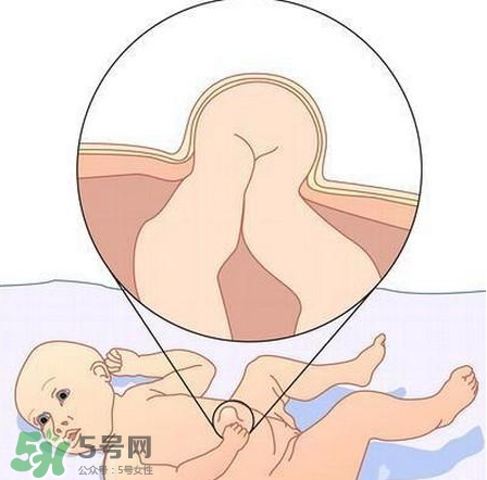 臍疝是什么？臍疝對寶寶有什么影響？