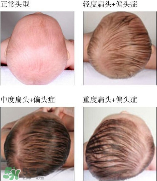 寶寶頭型是睡出來(lái)的嗎？寶寶頭型矯正最佳時(shí)間