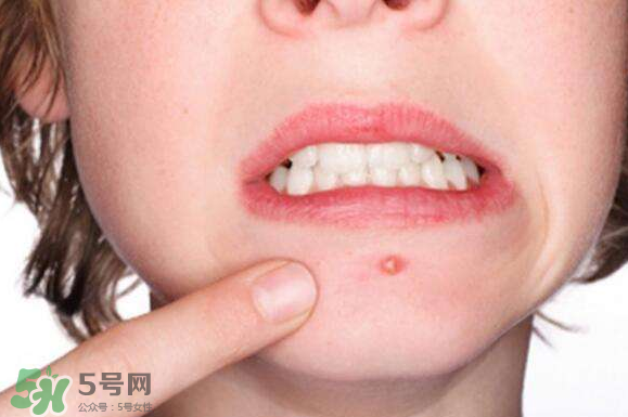 暗瘡可以擠壓嗎？油性和骯臟肌膚會容易有暗瘡嗎？