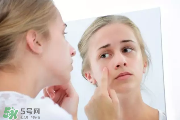 暗瘡可以擠壓嗎？油性和骯臟肌膚會容易有暗瘡嗎？