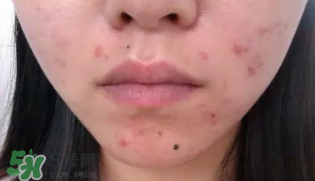 痤瘡和毛囊炎一樣嗎？痤瘡與毛囊炎區(qū)別