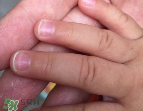 寶寶手指甲有白痕怎么回事？幼兒手指甲發(fā)白是缺鈣嗎