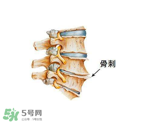 骨刺是怎么形成的？骨刺怎么治療？