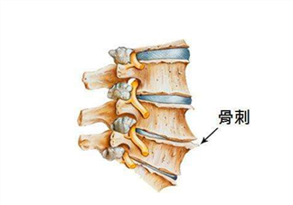 骨刺是怎么形成的？骨刺怎么治療？