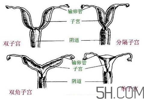子宮畸形有哪些？子宮畸形有什么影響？