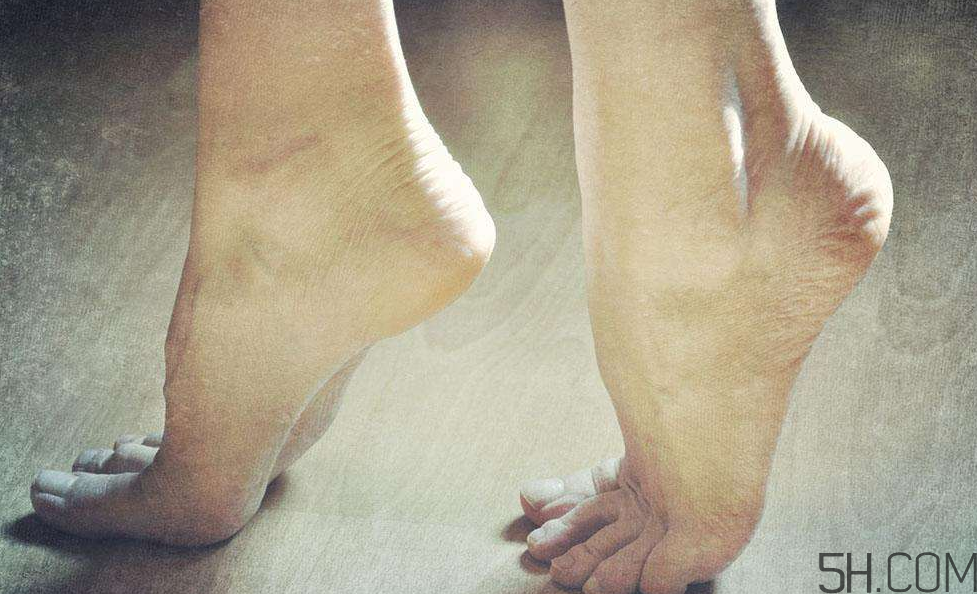 腳氣是什么原因引起的？腳氣是濕氣重引起的嗎?
