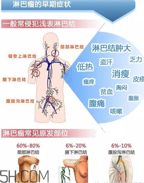 淋巴癌是怎么回事？淋巴癌如何診斷