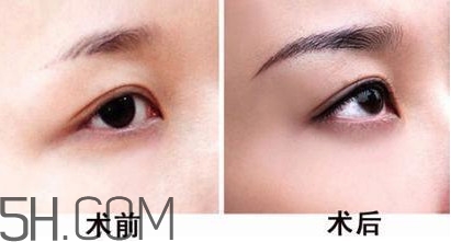 切眉手術(shù)后老得快嗎？切眉能保持多久？