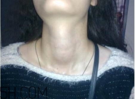 甲狀腺結(jié)節(jié)掛什么科？甲狀腺結(jié)節(jié)可以懷孕嗎