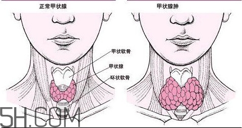 甲狀腺結節(jié)與甲狀腺腫瘤的區(qū)別有哪些？甲狀腺結節(jié)可以艾灸嗎