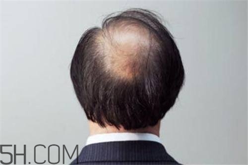 為什么男性比女性更容易脫發(fā)？什么原因?qū)е履行悦摪l(fā)？