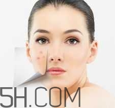 濕熱型痤瘡是什么？怎么調(diào)理濕熱型痤瘡？