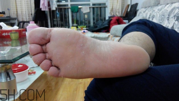 腳氣可以用酒精消毒嗎？腳氣可以用碘伏消毒嗎？