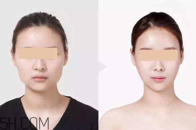 打瘦臉針可以抽煙嗎？打瘦臉針會(huì)反彈嗎？