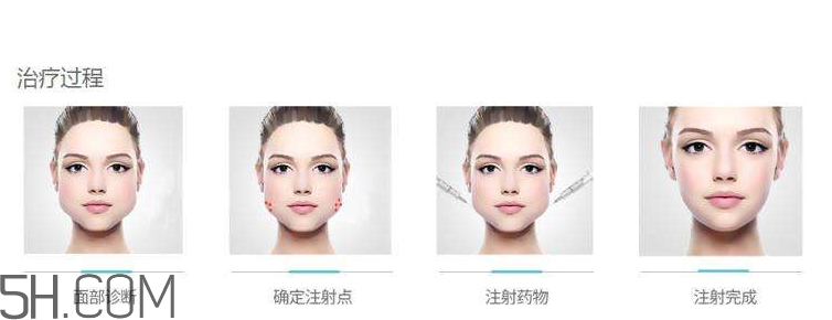 打瘦臉針可以抽煙嗎？打瘦臉針會(huì)反彈嗎？