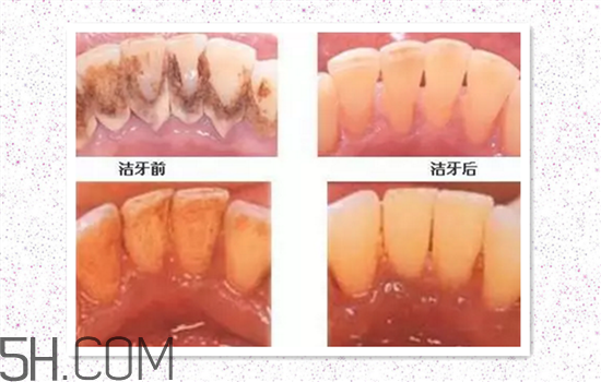 超聲波洗牙可以美白牙齒嗎？超聲波洗牙多少錢一次？
