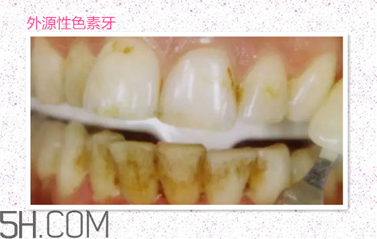 超聲波洗牙可以美白牙齒嗎？超聲波洗牙多少錢一次？
