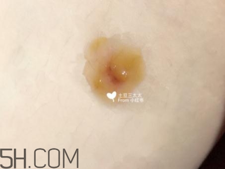 美寶濕潤(rùn)燒傷膏怎么樣？美寶濕潤(rùn)燒傷膏有用嗎？