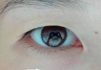 為什么會長脂肪粒？怎么消除眼睛上的脂肪粒？