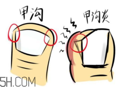 為什么容易得甲溝炎？怎么根治甲溝炎？