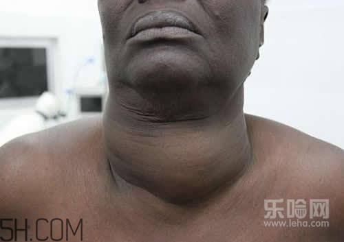 甲狀腺腫大和甲亢的區(qū)別有哪些？甲狀腺腫大適合吃什么食物？