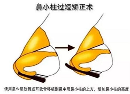 鼻小柱延長(zhǎng)用什么材料？?jī)?yōu)先選擇鼻中隔軟骨