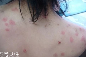 螨蟲有哪些危害？嚴重時肌膚糜爛