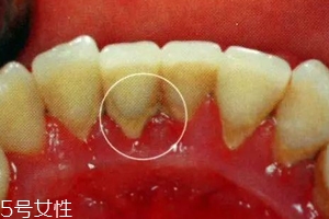 牙結(jié)石能自動脫落嗎？除了洗牙別無他法