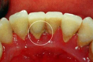 牙結(jié)石能自動(dòng)脫落嗎？除了洗牙別無他法