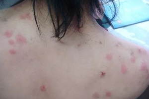 螨蟲有哪些危害？嚴(yán)重時(shí)肌膚糜爛