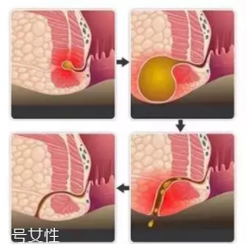 肛瘺非手術治療才可以嗎？手術是治療的關鍵途徑
